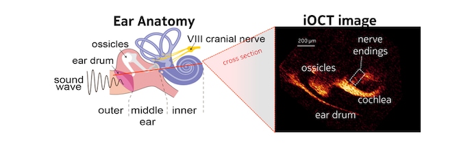 iOCT graphic
