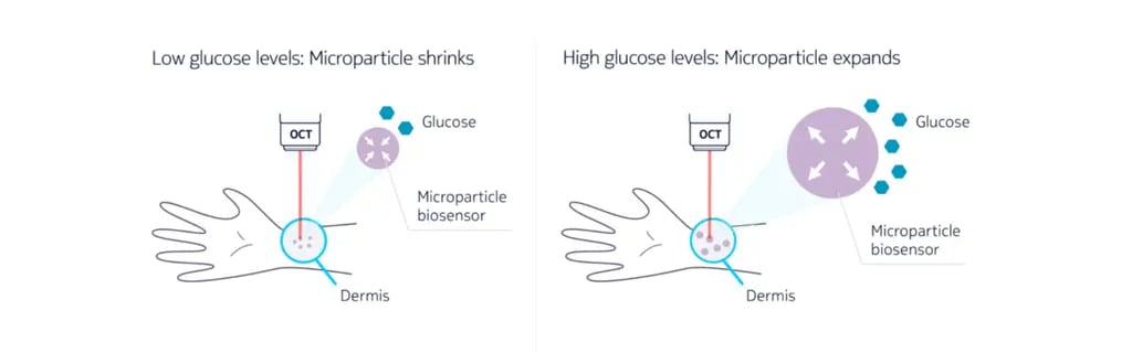 A diagram that illustrates how a microparticle biosensor implanted in the dermis can be used to detect glucose levels in the body. When glucose levels are low, the microparticle shrinks, and when glucose levels are high, the microparticle expands.